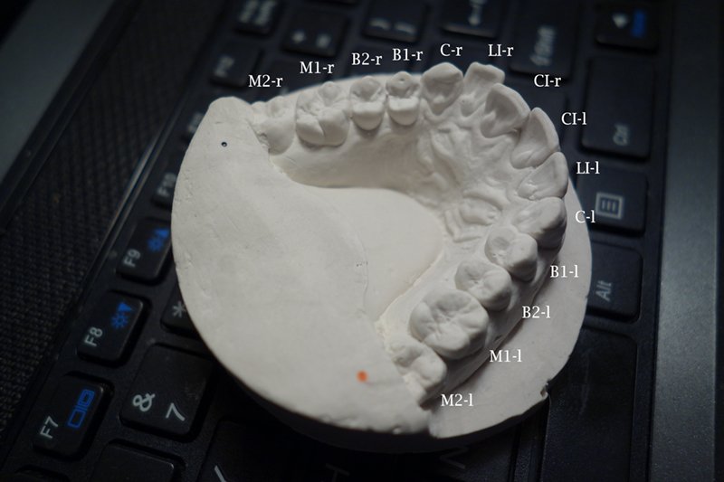 3D打印自制牙套：跟高价牙医说拜拜！